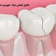 5 دلیل اصلی ترک خوردن دندان‌ها